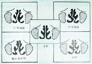 原三甲医生详解:鼻中隔偏曲主要症状有哪些?